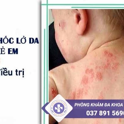 Bệnh chốc lở da ở trẻ em và cách chữa hiệu quả